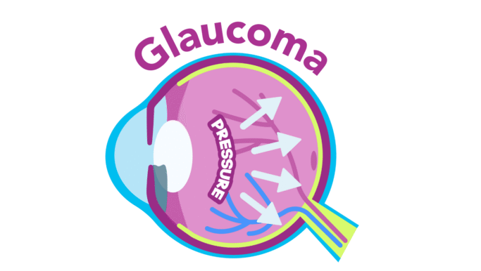 A simplified, colourful cross-section illustration of an eye showing increased internal pressure, represented by bold white arrows pushing outward. The word "PRESSURE" is written inside the eye, and the title "Glaucoma" is curved above the image in bold purple text.